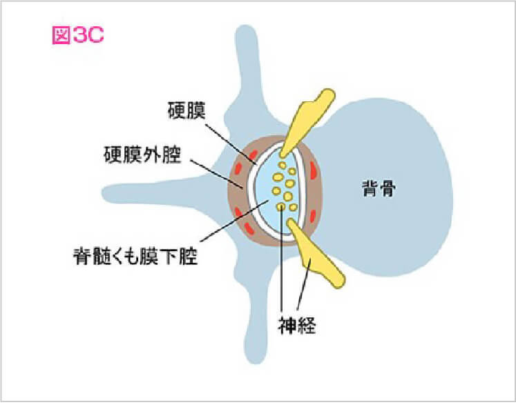 硬膜外麻酔についての説明図