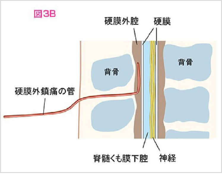 硬膜外麻酔についての説明図