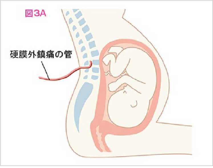 硬膜外麻酔についての説明図